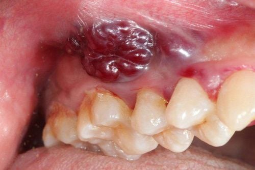 8 dấu hiệu cảnh báo ung thư khoang miệng- Ảnh 1.