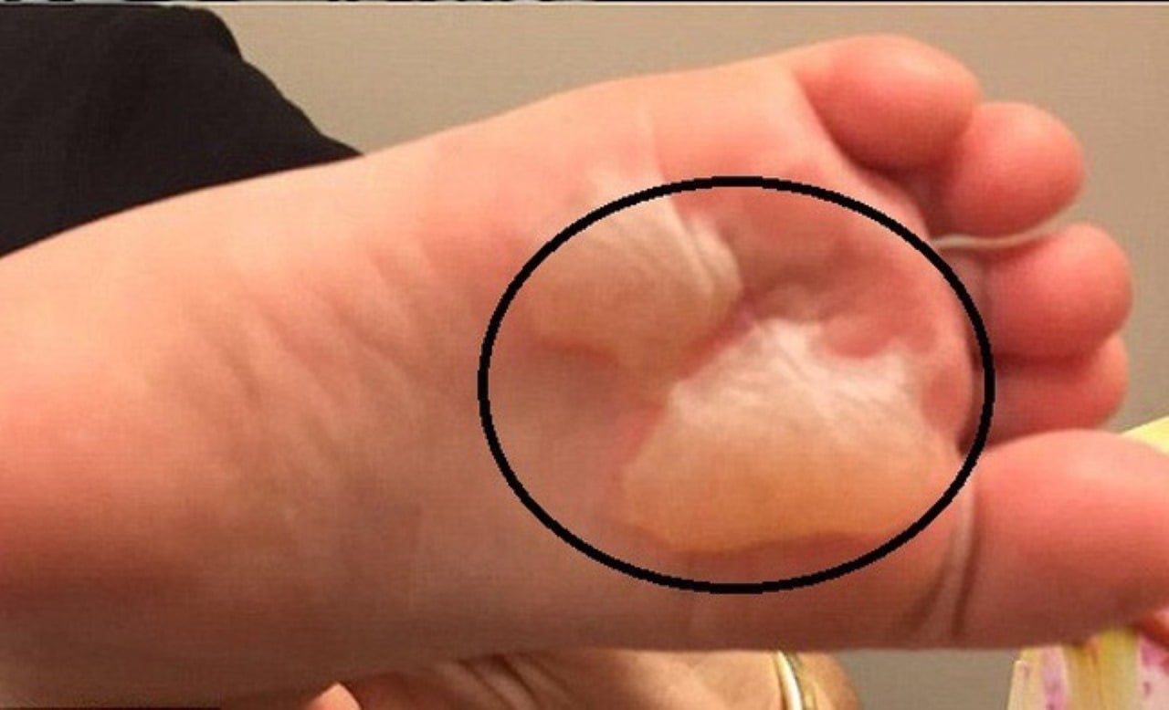 Cách chữa phồng rộp da chân khi đi bộ nhiều, mang giày chật. (Ảnh minh họa)