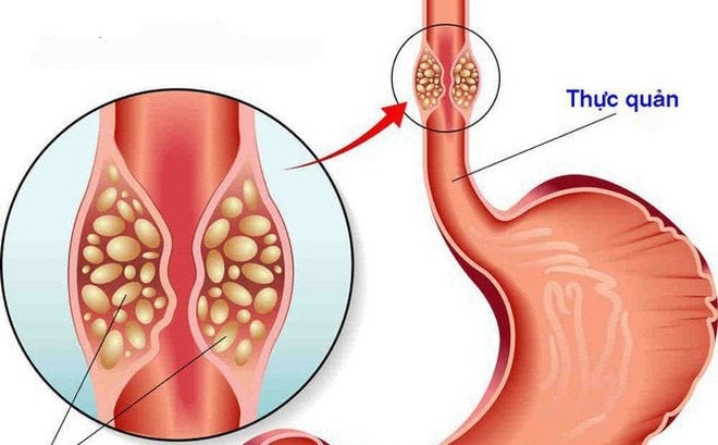 RSST không phải là mẹo dân gian, mà được chứng minh hiệu quả qua nghiên cứu đăng trên tạp chí Dysphagia của nhóm bác sĩ tại Trung tâm Y tế Sheba (Israel). 